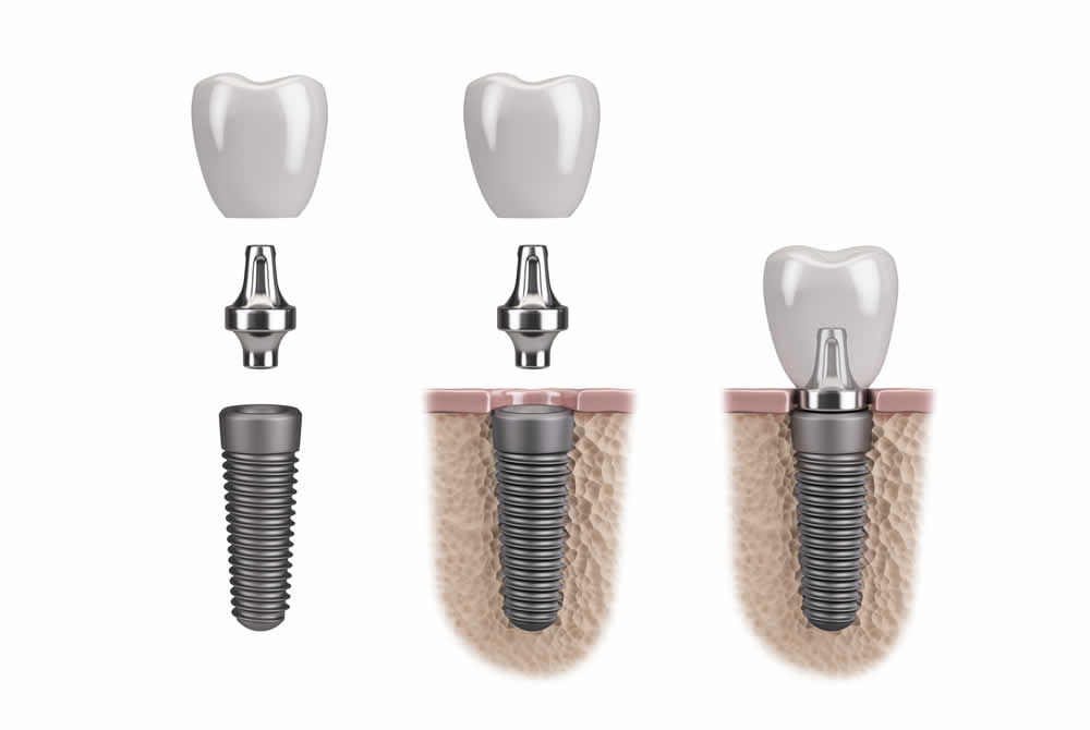 Dental Implants